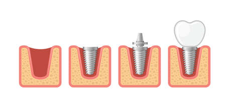 Dental Implant and Human Teeth Set. Vectorのイラスト素材