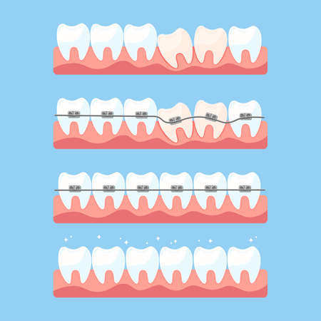 Alignment of teeth with braces setのイラスト素材