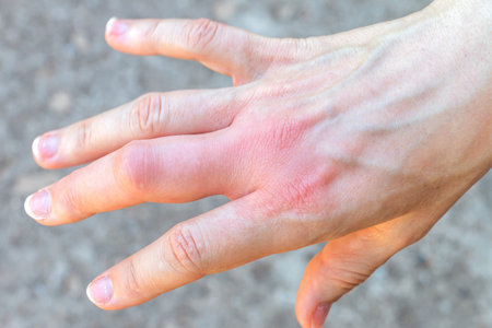 right hand with a swollen large middle finger after a bee bite, enlarged in size as a result of...