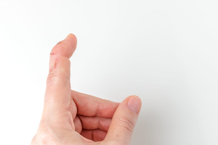 cut index finger with a extensor tendon injury, mallet finger, fingertip bending downwards while the...