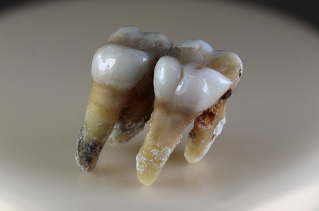 A damaged human tooth. The background is black and blurry. Close-up.の写真素材
