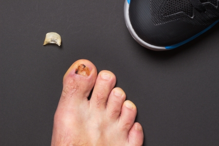Consequences of wrong sized sport shoeの写真素材