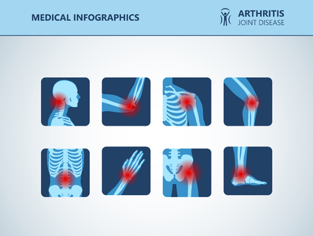 Rheumatism or rheumatic disorder medical set. Arthritis joint pain syndrome. Different body parts with pain rings on hand, leg and feet, spine, scull, pelvis. Rheumatology vector infographics elementsのイラスト素材