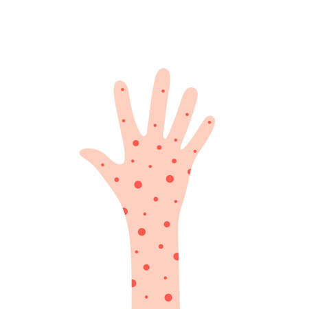 cartoon hand with rash like allergyのイラスト素材