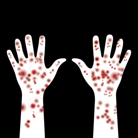 Painful rash on hands. Spots on hands with white skin tone. Symptoms of patient with meningitis. Disease manifestation signs. Rash, dermatitis, allergies or pimples on hands. Medicine or dermatology.のイラスト素材