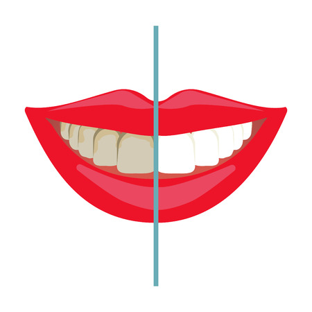 Teeth whitening before and after results. Dental bleaching, teeth smile, tooth treatment comparisonのイラスト素材