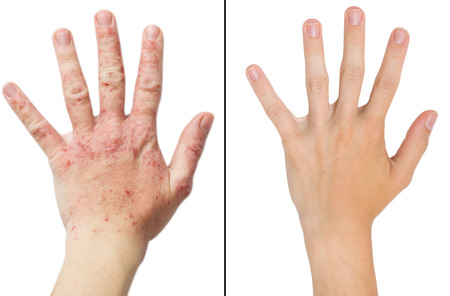 Real photo girl's hand, the patient with eczema before and after treatment. Isolated white...