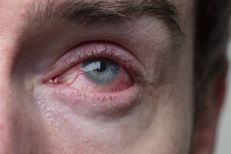 Close up of a severe bloodshot eye. Blepharitis, Conjunctivitis conditionの写真素材