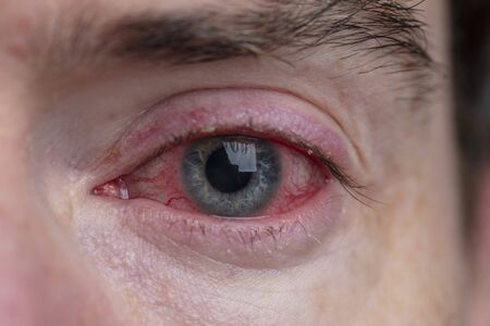 Close up of a severe bloodshot eye. Blepharitis, Conjunctivitis conditionの写真素材