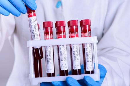 COVID-19 test and laboratory sample of blood testing for diagnosis coronavirus infection in the hands of the laboratory assistant isolated on white background and space for ads conceptの写真素材