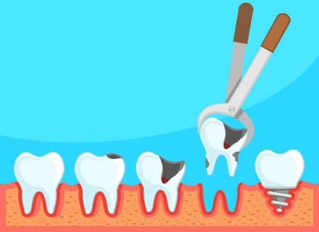 Dental treatment. Removing a diseased tooth and installing an implant close-upのイラスト素材