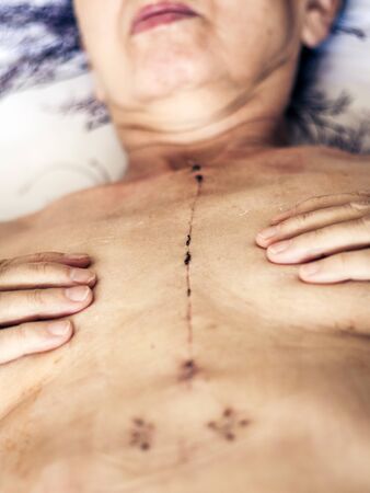 Scar from open heart surgery on the female body, where the sternum was cut in two, and the rib cage sprung. Image taken 30 days (1 month) following surgeryの写真素材
