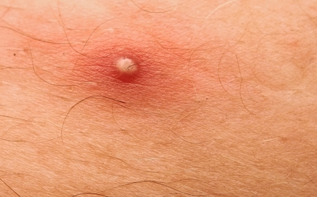 Pimple Extreme Macro の写真素材