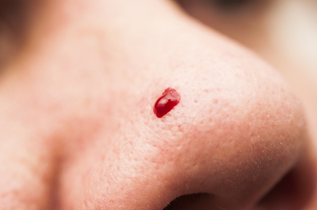 adult human nose injury blood