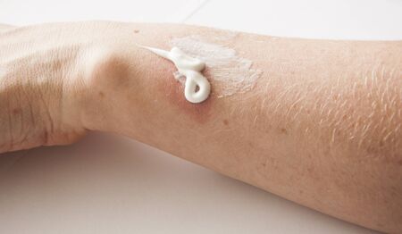 A woman applying scars removal cream to heal the first degree - heat burn wound on her hand.
