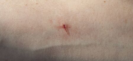 Arm is wound from a knifeの写真素材