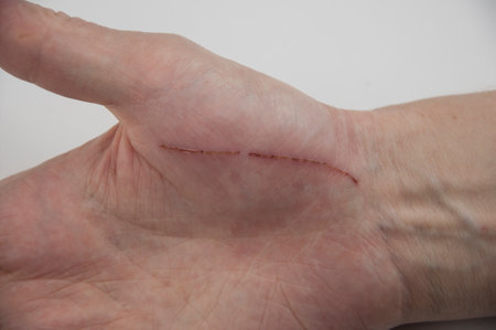 Hand of man injured wound from accident, insurance conceptの写真素材
