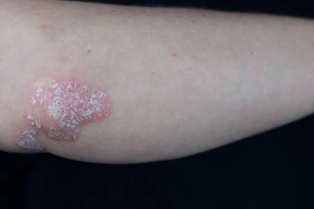 Acute psoriasis on the elbows is an autoimmune incurable dermatological skin disease. Large red, inflamed, flaky rash on the elbows. Joints affected by psoriatic arthritisの写真素材