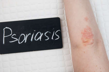 Acute psoriasis on the elbows is an autoimmune incurable dermatological skin disease. Large red, inflamed, flaky rash on the elbows. Joints affected by psoriatic arthritisの写真素材