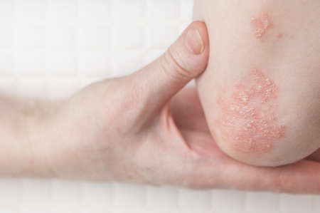 Acute psoriasis on the elbows is an autoimmune incurable dermatological skin disease. Large red, inflamed, flaky rash on the elbows. Joints affected by psoriatic arthritisの写真素材