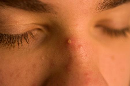 A young male with a pimple or acne directly on the middle of his nose between both eyes. Close up...