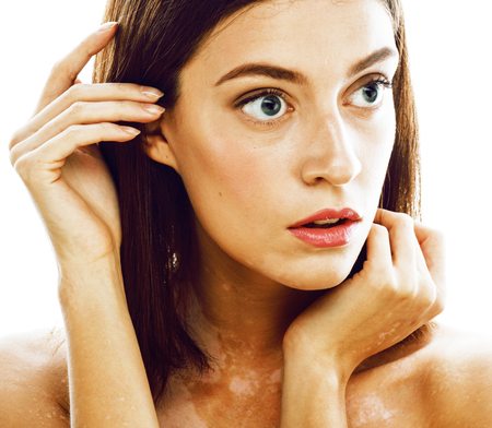 beautiful young brunette woman with vitiligo disease close up isの写真素材