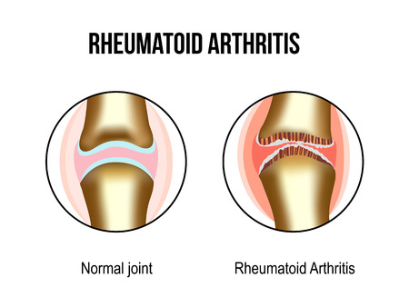 Normal and rheumatoid arthritis jointsのイラスト素材