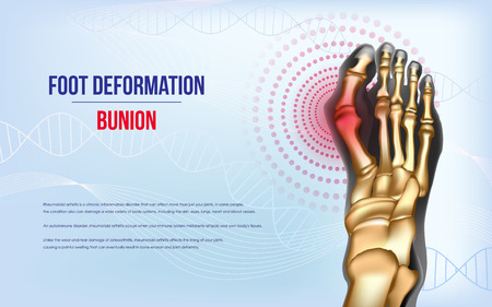 Foot deformation Bunionのイラスト素材