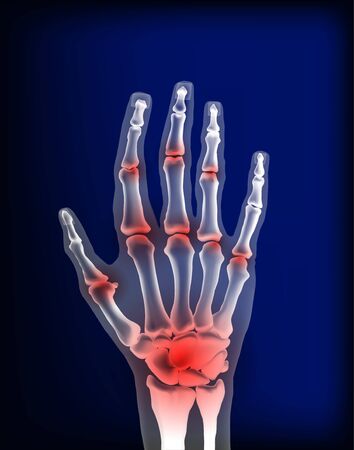 Osteoarthritis image sore inflammation joints of bones the of hand.のイラスト素材