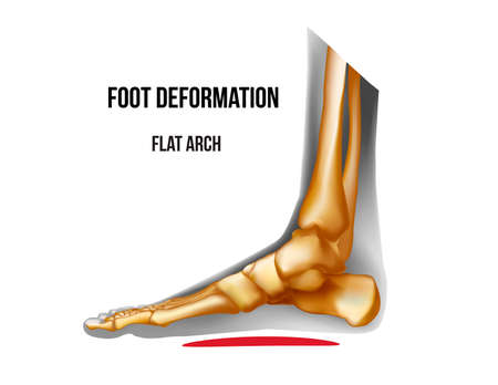 Foot flat arch deformation. Bones skeleton realistic anatomy illustrationのイラスト素材