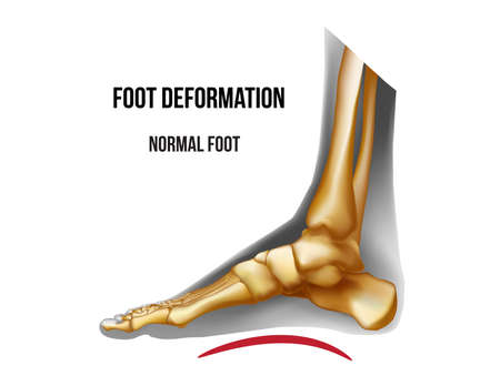 Foot deformation. Normal arch bones skeleton realistic anatomy illustrationのイラスト素材