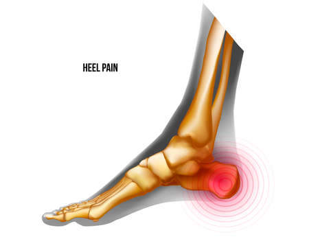 Heel of foot pain bones skeleton realistic anatomy illustrationのイラスト素材