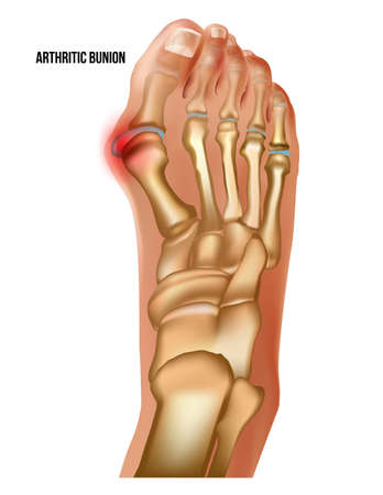 Artritic bunion rheumatoid sore joints, top view.のイラスト素材