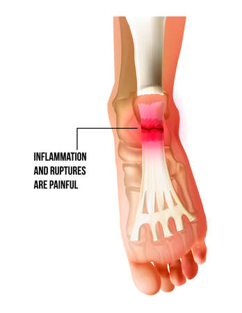 Foot pain, plantar fasciitis inflammation and ruptures strain bottom view. Realistic anatomy illustrationのイラスト素材