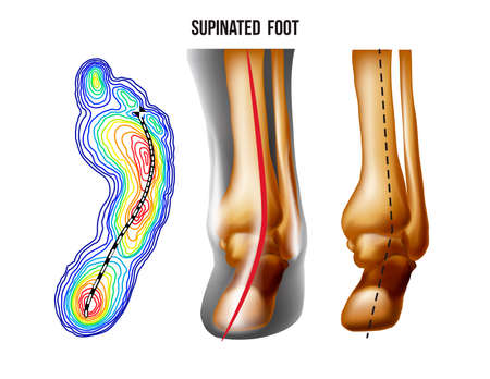 Supinated foot, arch deformation, bottom and back view . Foot weight distribution.のイラスト素材