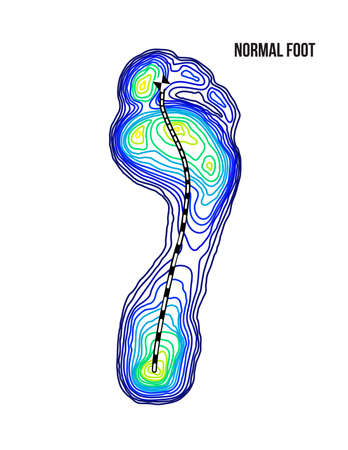 Foot weight distribution. Normal arch foot bottom thermal view. No deformation.のイラスト素材