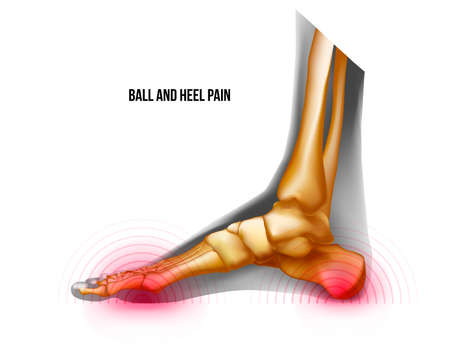 Ball and heel of foot pain bones skeleton realistic anatomy illustrationの写真素材