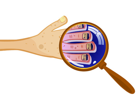 Groomed hand under a magnifying glass. Dirty fingernails. Nail fungus. Isolated comical picture.のイラスト素材