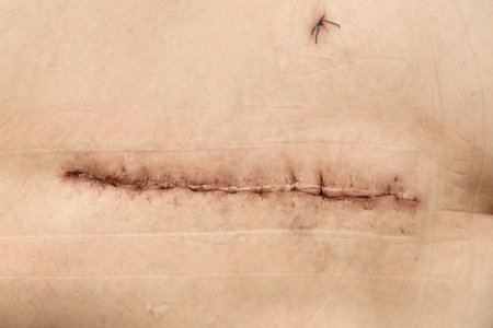 Surgery on the hip. Postoperative suture on the skin with iodine. Un Stitched up skin after an...