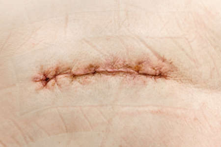 Postoperative healing suture on human skin with slight redness and traces of the plasterの写真素材