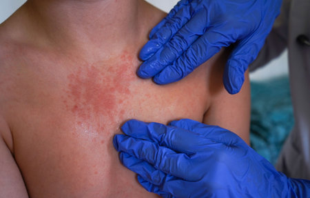 The doctor observes the boy for symptoms of chickenpox.の写真素材