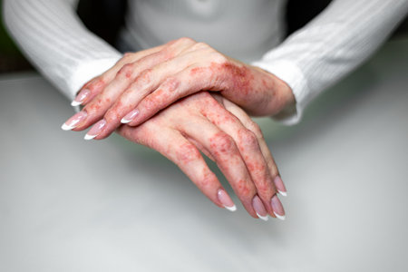 Hands showing signs of eczema, contact dermatitis, and psoriasis in a clinical settingの写真素材