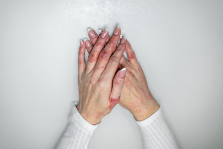 Hands showing signs of eczema, contact dermatitis, psoriasis, and fungal infection in a bright indoor settingの写真素材