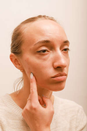 Teenage girl points a finger at her cheek with acneの写真素材