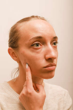 Teenage girl points a finger at her cheek with acneの写真素材