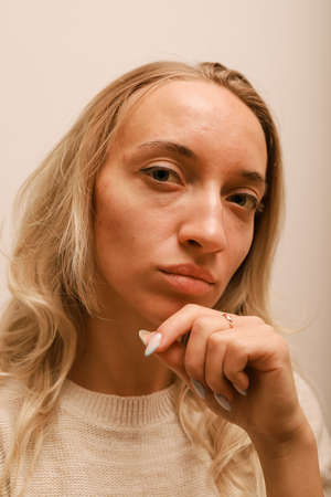 A woman with blonde hair and skin with acne leaning on her arm is sadの写真素材