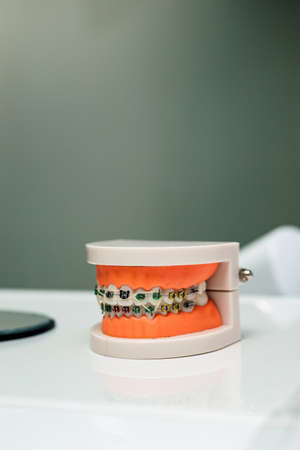A model of the jaw with braces lies on the table at the orthodontistの写真素材