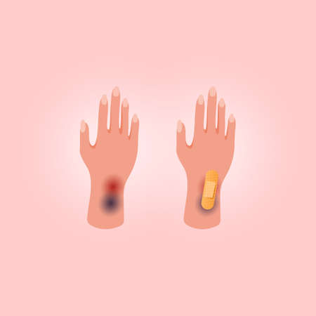 Physical injury human hand with open cut. Medical adhesive plaster on pink background. Flat lay style.のイラスト素材