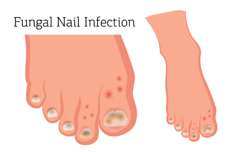 Fungal diseases of the nails and skin of the feet. Athlete's foot, onychomycosis, candidiasis. Vector illustration of medical posters and standsのイラスト素材