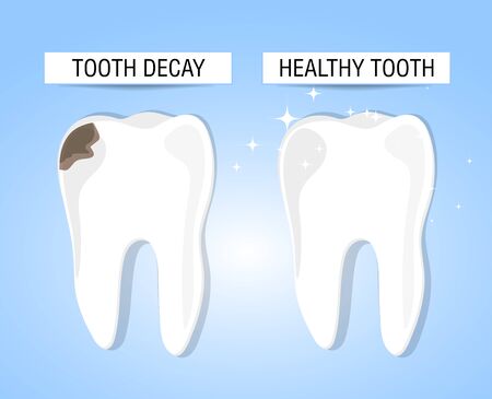 The concept of healthy and diseased tooth. Visual aid for students, dentists, patients of the clinic. Defeat caries, the focus of destruction in the teeth. Vector illustrationのイラスト素材